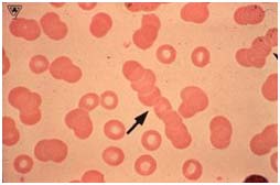 Các tế bào hồng cầu khỏe mạnh bao quanh bởi điện tích âm giúp đẩy mạnh khi chúng chạy qua hệ tuần hoàn