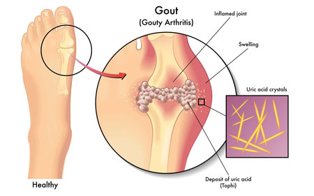 Nước ion kiềm giàu hydro hỗ trợ người bị bệnh Gout